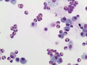 Bronchoalveolar lavage fluid from asthmatic cats typically contain excessive eosinophils. These cells contain pink-staining granules that are released during inflammation and cause damage to the airways.