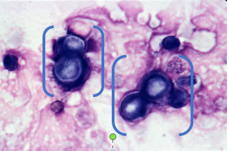 Figure 5: B. dermatitidis (as indicated by brackets); Image: Dr. Royal MU VHC Clinical Pathology
