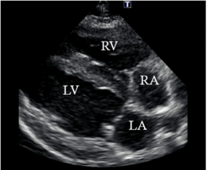 Pulmonary Hypertension